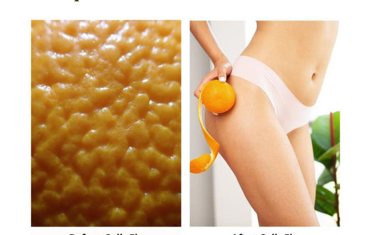 Cellulite Reduction with CelluFix Cupping Therapy