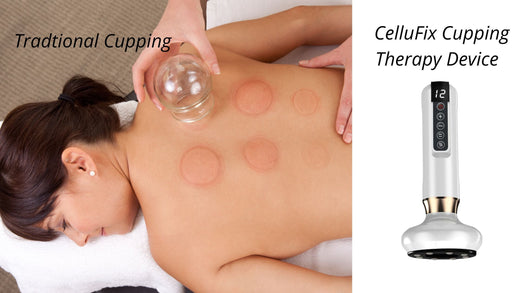 The Benefits of Cupping Therapy